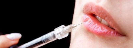 Lips injection. Beauty standard. Beauty injection. Lip filler injections. Lip augmentation. Sexy Mouth close-up. Injecting filler into lips. Advertising concept for cosmetology. Youth and beauty.の写真素材