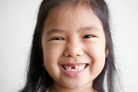 closeup face asian child cute or kid girl smile white teeth and one broken tooth or drop from baby...
