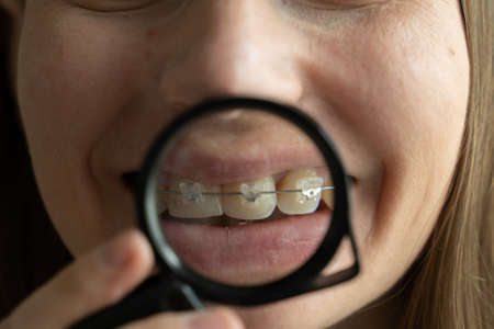 Woman showing her braces in magnifying glassの写真素材