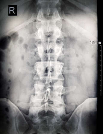 X-ray of a human spineの写真素材