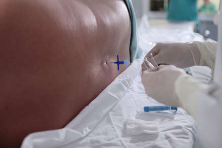 Injections of spinal anesthesia.Injections of epidural anesthesia in preparation for vascular surgery.Close-up. Concept of healthcare and medicine.Close-up.の写真素材