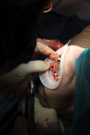 Installation of dental implants and tooth extraction in dental clinic under general anesthesia. Modern dentistry. Close-up. Beyond recognition. Vertical photo.の写真素材
