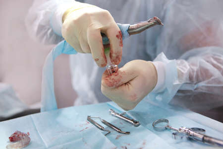 Dentist surgeon pulls out a new dental implant. Installation of implants in a modern dental clinic. Blood on the gloves. Only hands. Close-up. Copy space.の写真素材