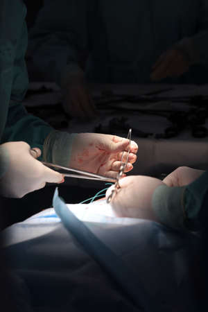 The surgeon sutures after laparoscopic surgery. Completion of the operation to remove the inguinal hernia. Modern surgery. Unrecognizable persons. Vertical photo.の写真素材