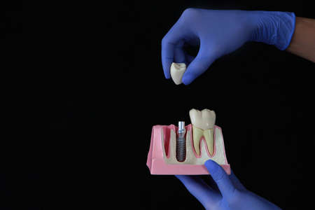 The concept of installing dental implants. Visual demonstration on layout. Dental implant. The concept of dentistry and dental care. Examination at the dentist.Black background.With copy space.の写真素材