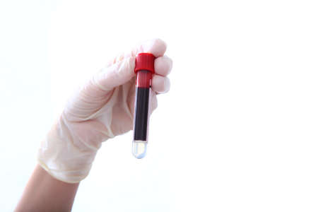 A syringe in the hands of a nurse. Taking tests in a medical laboratory. Hands in protective gloves close-up.の写真素材