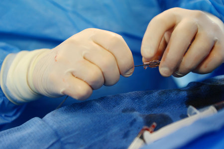 Operations to remove blood clots. Prevention of blood clots. Endovascular surgery. Surgical interventions on blood vessels.の写真素材