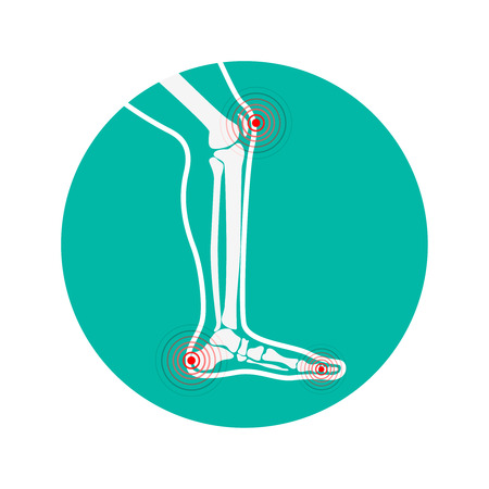 Human leg pain zones. Design elements for infographic. Vector illustration.のイラスト素材