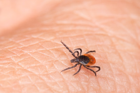 Black-legged or deer tick on human skin detail. Ixodes. Parasitic insect mite - bacterial or viral pathogens carrier. Lyme disease or tick-borne encephalitis.の写真素材