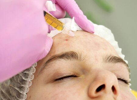 plasmolifting injection procedure. plasma injection into the skin of the patient's forehead. Selective focusの写真素材