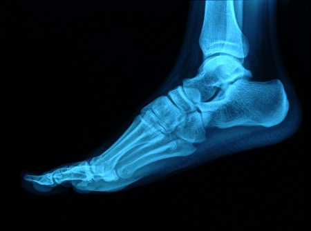 Xray footの写真素材