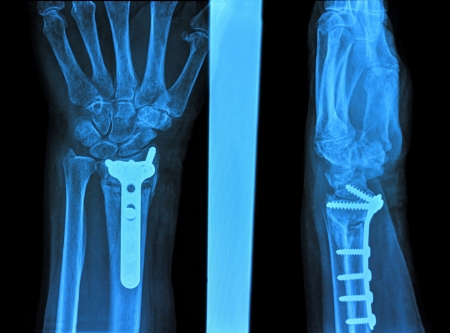 Hand xray image medical backgroundの写真素材
