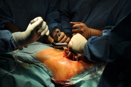 Prosthesis of the hip hospital operation の写真素材