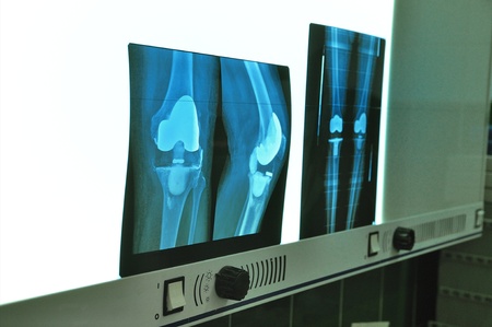 Xray knee prosthesisの写真素材