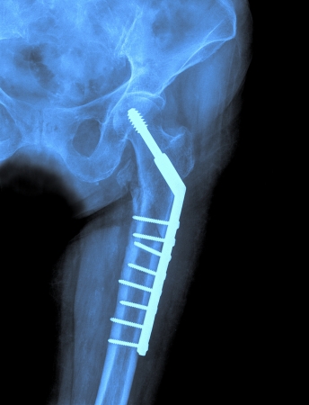 Hip xray image medical backgroundの写真素材