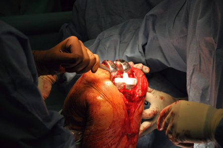 Prosthesis of the knee hospital operation