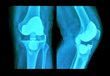 xray knee prosthesisの写真素材