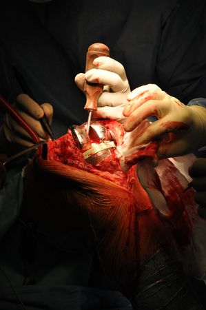 Prosthesis of the knee hospital operationの写真素材