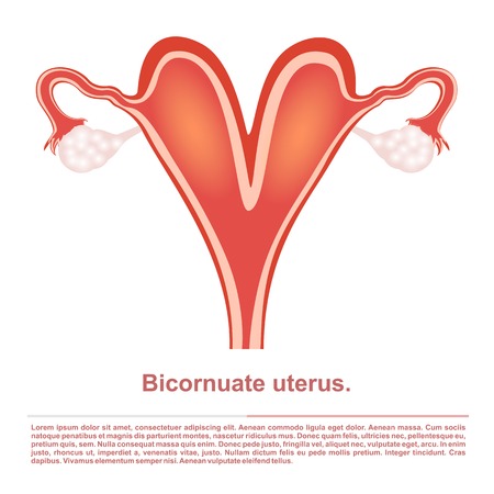 Illustration, female reproductive organ bicornuate uterusobstetricsのイラスト素材