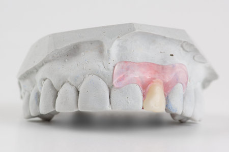 dentures made of nylon type of butterfly is made of one missing tooth