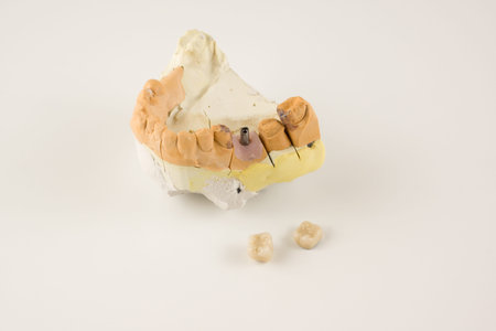 dental prosthesis manufacturing step in dental laboratories