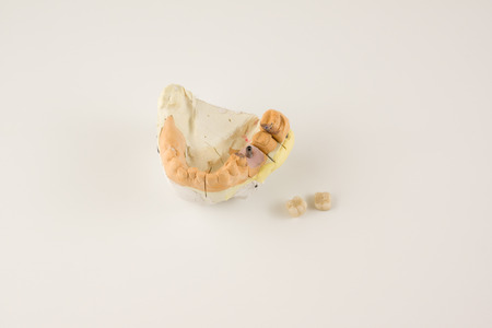 dental prosthesis manufacturing step in dental laboratoriesの写真素材