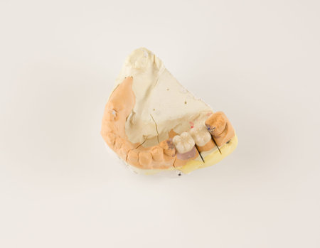 dental prosthesis manufacturing step in dental laboratories