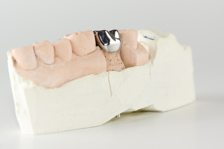 cast metal dental crown on artificial plaster modelの写真素材