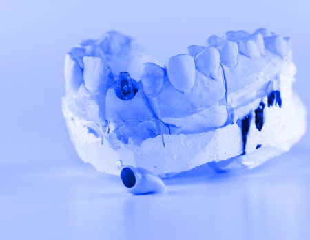 metal-ceramic dental crown is tried on an artificial model