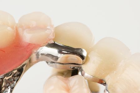 Clasp prosthesis with lock fixation on a white backgroundの写真素材