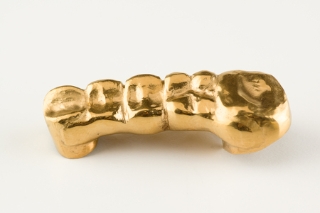 steel bridge-like dental prostheses to restore the integrity of the dentitionの写真素材