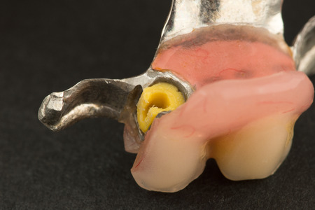image of a modern arc  denture with attachment on a black backgroundの写真素材