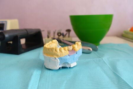 metal ceramic dental crowns on artificial gypsum models at the dentist officeの写真素材