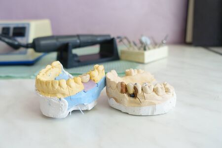 metal ceramic dental crowns on artificial gypsum models at the dentist officeの写真素材