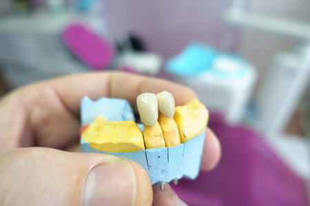 close-up ceramic tooth crown on a plaster model of teeth in the dentist's hand work of a dental...