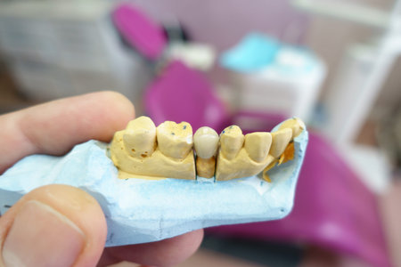 close-up ceramic tooth crown on a plaster model of teeth in the dentist's hand work of a dental...