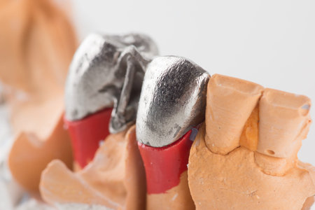 Steel artificial dental bridge for dentition restoration