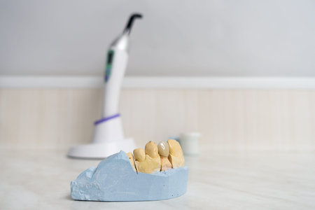 dental ceramic crown on a plaster model stands on a table
