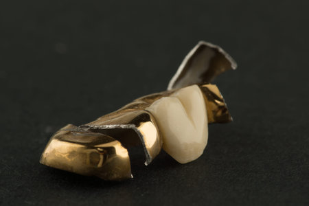 damaged stamped brazed dental bridge isolated on the background