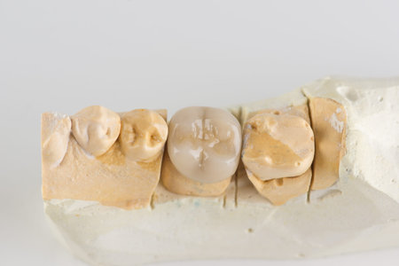 metal ceramic dental crown photographed close-up on a white background
