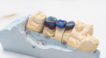 Artificial teeth are made of wax for the patient