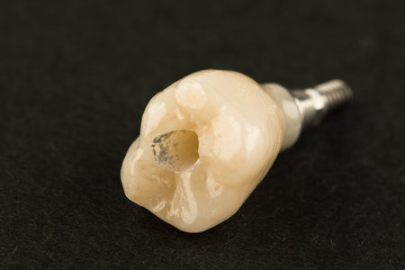 ceramic dental crown for fixation on a dental implant isolation on black backgroundの写真素材