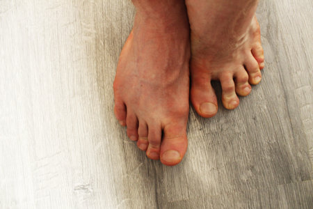 Male feet on the floor, top view. Diseases of the legs.