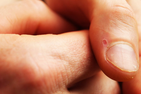 Wound on the burrs of a finger close-up.の写真素材