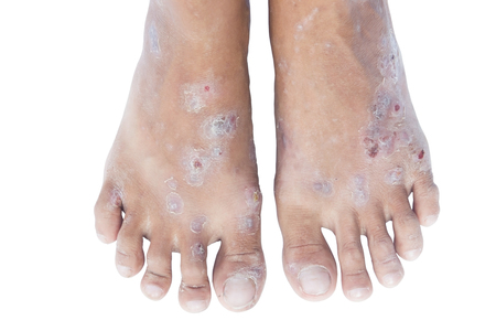 Foot syndrome.の写真素材