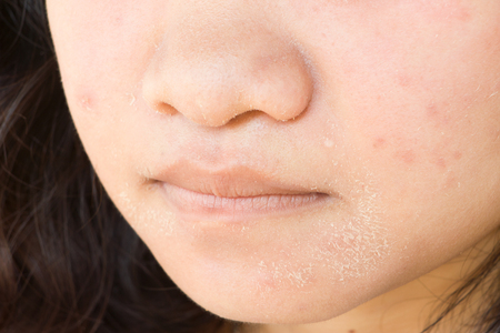 Cracks on the girl's face from acne.の写真素材