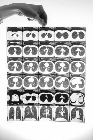 Closeup black and white shot of man holding film with lungs tomography result