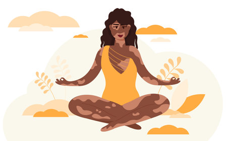 Vector illustration of a beautiful woman with a Vitiligo.Love yourself.Body positive.のイラスト素材