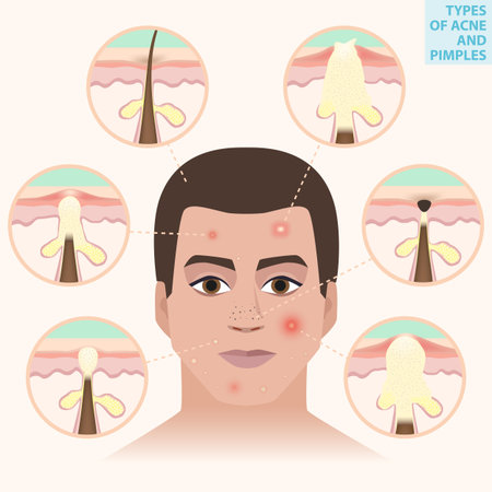 Distressed leather men, types of acne and pimples illustrationのイラスト素材