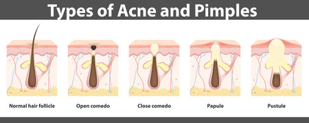 Types of acne,  structure of  pimple, detailed drawing, illustrationのイラスト素材